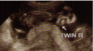 Twin B's side profile of face and you can she his/ her spinal cord and back 